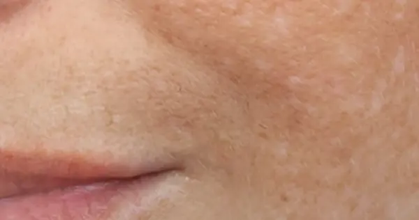 Contentpigmentedlesions Min