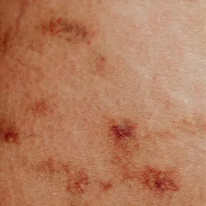 Skinhyp300x300 Min