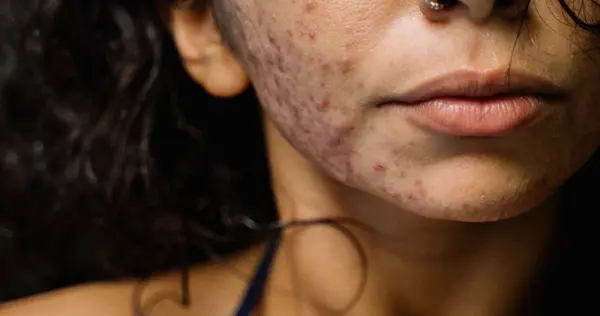 Acne Primelase Min